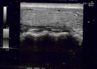 Imagen ecografica tiroides